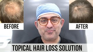 Topical Finasteride and Minoxidil HAIR LOSS Solution [upl. by Aneehta]