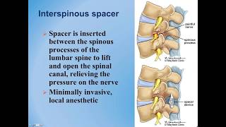 Lumbar Spinal Stenosis  Diagnosis and Treatment Options [upl. by Vano569]