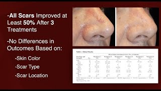 Can Microneedling Improve Scars Plastic Surgery Hot Topics with Rod J Rohrich MD [upl. by Mellie]