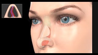 Deviated Septum Surgery Septoplasty [upl. by Dacie]